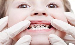 Çocuklarda diş çürüğü neden olur?
